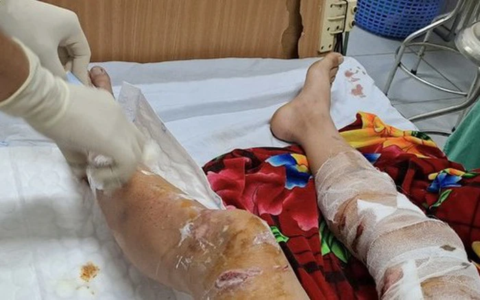 Chấn thương tại vùng chân của Nam sinh Chấn thương tại vùng chân của Nam sinh