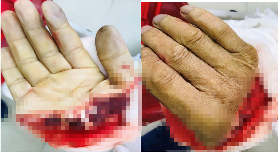 Cận cảnh bàn tay bị đứt lìa 