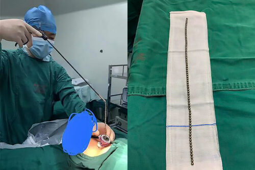 Ca phẫu thuật lấy chùm bi ra